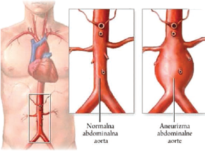 Aneurizma aorte, trbušna aneurizma, grudna, proširenje, uzrok, lečenje