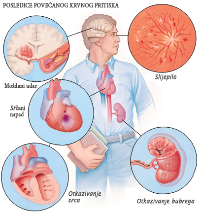 Arterijska hipertenzija (Povišen krvni pritisak)