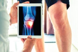 revoluciju u liječenju osteoartritisa
