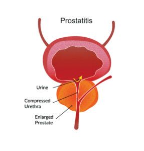 akutni prostatitis Krónikus prosztatitis depresszió