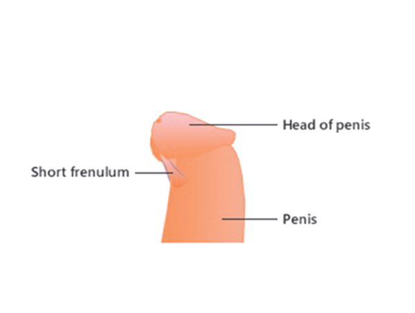 Frenulum breve penis I tied