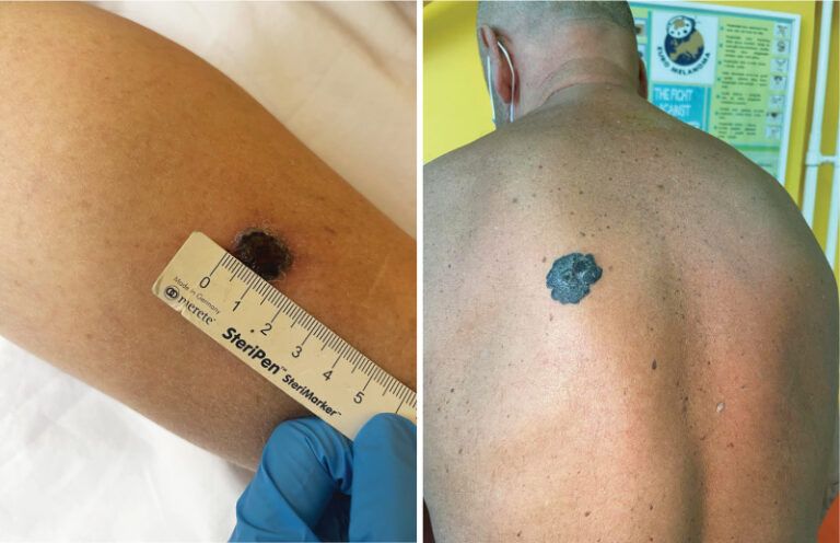 Značaj prevencije u dijagnostici i liječenju melanoma kože i cilj Euromelanoma kampanje