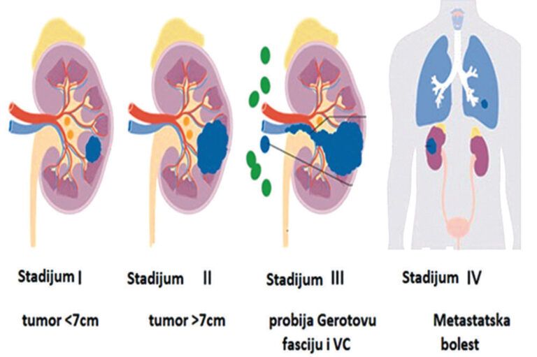 Karcinom bubrega – potencijalno izlječiva bolest ukoliko se otkrije u ranom stadijumu