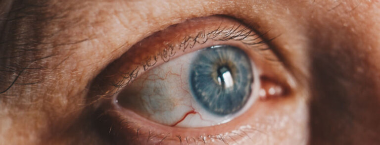 Primjena protetskog mekog kontaktnog sočiva za trakastu keratopatiju rožnjače