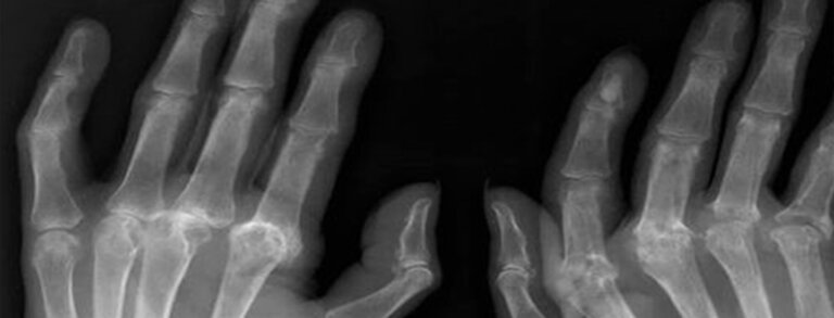 Savremeni pristupi liječenju reumatoidnog artritisa